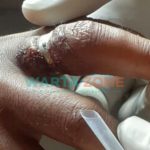 Detik-detik Dramatis Pemotongan Cincin oleh Petugas Dampak Jember Gunakan Gerenda, kepada Hilman, Warga Desa Pakisan, Kabupaten Bondowoso.