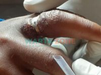 Detik-detik Dramatis Pemotongan Cincin oleh Petugas Dampak Jember Gunakan Gerenda, kepada Hilman, Warga Desa Pakisan, Kabupaten Bondowoso.