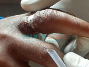 Nyaris Diamputasi, Detik-detik Dramatis Pemotongan Cincin oleh Petugas Dampak Jember Gunakan Gerenda