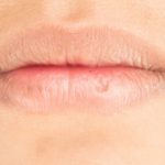 Cara Ampuh Mengatasi Bibir Kering dan Pecah