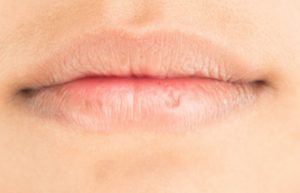 Cara Ampuh Mengatasi Bibir Kering dan Pecah