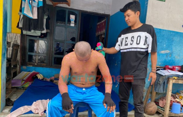 Sekujur Tubuh Banyak Ruam, Warga Jember Ini Tak Bisa Bekerja dan Dikucilkan Tetangga Rumah